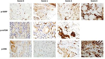 Phosphorylation of S6RP in peritubular capillaries of kidney grafts and circulating HLA donor-specific antibodies